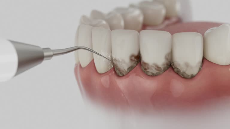 Trusted Dental Implants service in Greenwood Village, CO - Dentist Open Now